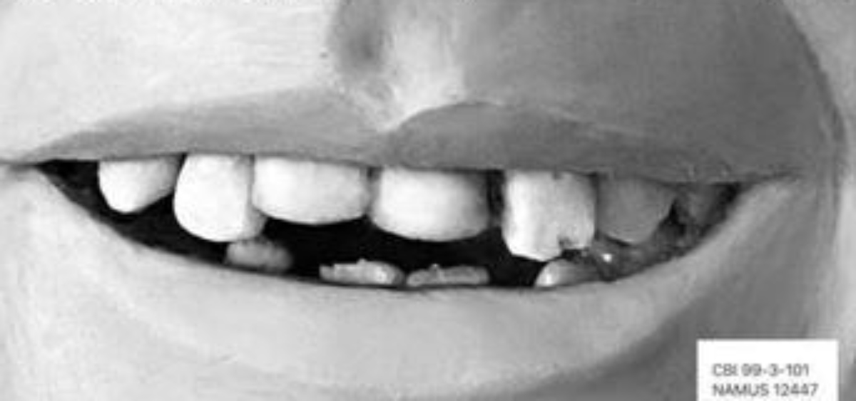 Close up of teeth of Jane Doe from Huerfano County, CO.